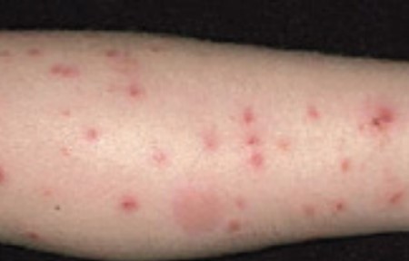 Insect Bite